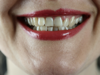 teeth whitening in Nairobi